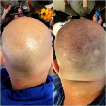 nYou Image Ink - Before/After - Hair Loss Centers Near Me - San Jose, California nYou Image Ink - Before/After - Hair Loss Centers Near Me - San Jose, California