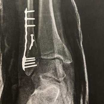 Andrew Rosenbaum MD - plate and screws inserted during 1st surgery - Podiatrists Near Me - Albany, New York Andrew Rosenbaum MD - plate and screws inserted during 1st surgery - Podiatrists Near Me - Albany, New York