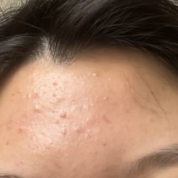 Beauty Legend - After treatment - Skin Care Near Me - Fremont, California Beauty Legend - After treatment - Skin Care Near Me - Fremont, California