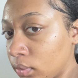 After Hydrafacial
