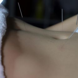 Doral Acupuncture