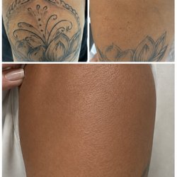 MEDermis Tattoo Removal - Partial Tattoo Removal in Just 3 Treatments  Not every client wants an entire tattoo removed.