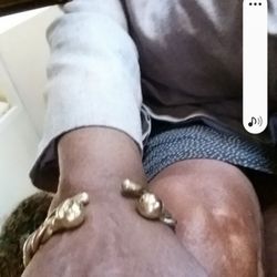 Chicago Police Department - My frostbitten hand & knee.