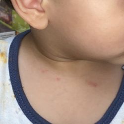 Belleair Montessori Academy - Scratches on baby neck from a different kid finger nails