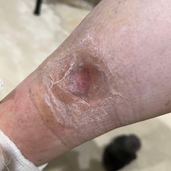 Suzuki Wound Care Clinic - This is my mom's wound now 09/16/24