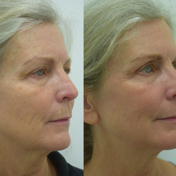 Skin Deep Laser Services - Tattoo Removal Near Me - Burke, Virginia