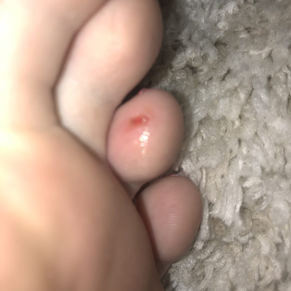 VIVY NAILS - Deep cut in toe - Nail Salons Near Me - WOODRIDGE, Illinois VIVY NAILS - Deep cut in toe - Nail Salons Near Me - WOODRIDGE, Illinois