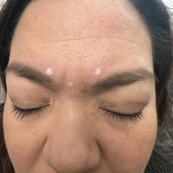 KQ Aesthetics - BOTOX mapping