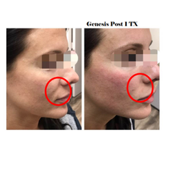Our real patient Genesis 1 treatment done.