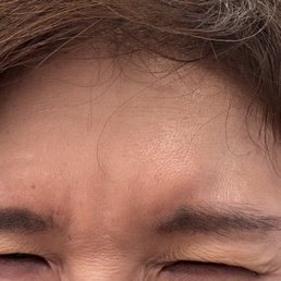 AFTER Botox for forehead and 11 lines AFTER Botox for forehead and 11 lines