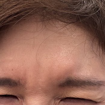 NakedMD - AFTER Botox for forehead and 11 lines - Medical Spas Near Me - San Jose, California NakedMD - AFTER Botox for forehead and 11 lines - Medical Spas Near Me - San Jose, California