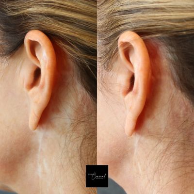 Medical Body Blending