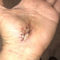 Left hand carpal tunnel release not healing well