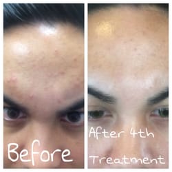 Skin and Lash Lady - before treatment & after 4th botanical peel.