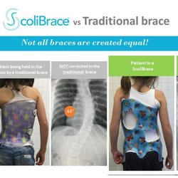 Action Sports Chiropractic & Family Wellness - ScoliBrace for Kids.