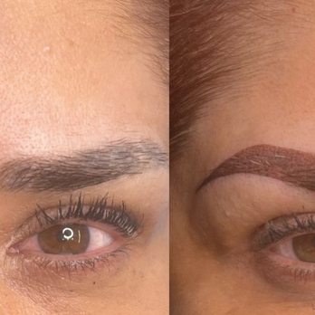 luxx beauty clinic - This is my before and after. - Skin Care Near Me - Westminster, California luxx beauty clinic - This is my before and after. - Skin Care Near Me - Westminster, California