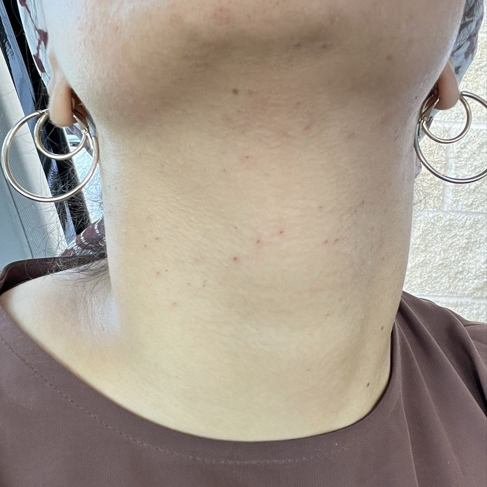 Devi's threading - scabbing on my neck where small blood holes were forming the day before, never happened in my 6 years of threading - Eyebrow Services Near Me - Pawtucket, Rhode Island