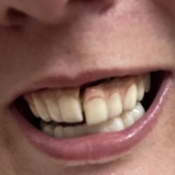 Dental Express - My "Smile" today