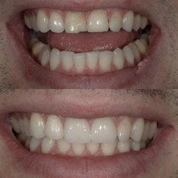 Bridgeport Aesthetic Dentistry - Dr. Sal placed 2 central veneers.