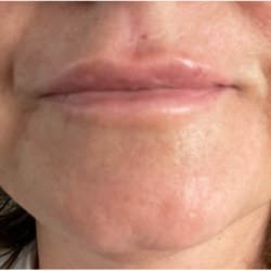 Dr. Thompson's lip injection filler procedure photo taken the day after treatment.