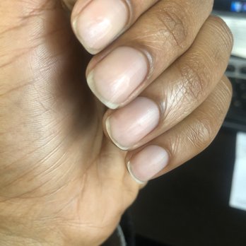 Nail Shack Salon & Spa - Dented/whittled nails from using a drill bit instead of acetone soak to remove a gel manicure. - Nail Salons Near Me - Atlanta, Georgia Nail Shack Salon & Spa - Dented/whittled nails from using a drill bit instead of acetone soak to remove a gel manicure. - Nail Salons Near Me - Atlanta, Georgia