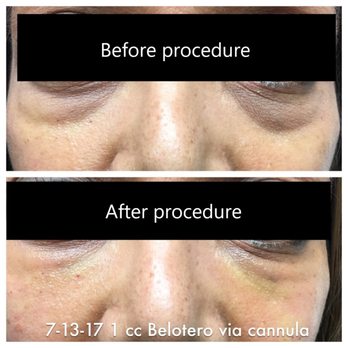 Karen Struck, RN - Before and after pictures of my lower eyelids. See how deep my eye-bags were in the before picture? Karen did an amazing job! - Medical Spas Near Me - Atherton, California Karen Struck, RN - Before and after pictures of my lower eyelids. See how deep my eye-bags were in the before picture? Karen did an amazing job! - Medical Spas Near Me - Atherton, California