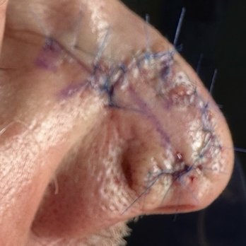 Shervin Aminpour, MD - After surgery to close hole from skin cancer removal. - Ear Nose & Throat Near Me - West Hills, California Shervin Aminpour, MD - After surgery to close hole from skin cancer removal. - Ear Nose & Throat Near Me - West Hills, California