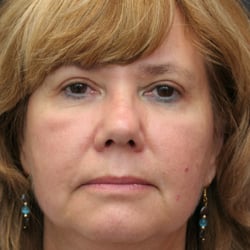 Stuart Bentkover, MD - A 57 year old young lady after an upper eyelid blepharoplasty by Dr.Bentkover. This is about a 45 minute procedure in the office