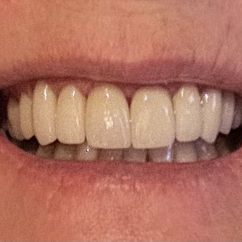 Gold River Smiles - After - Cosmetic Dentists Near Me - Gold River, California Gold River Smiles - After - Cosmetic Dentists Near Me - Gold River, California