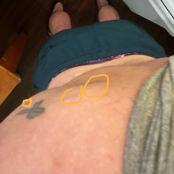 La Serena Inn - Bed bug bites - Hotels Near Me - Morro Bay, California