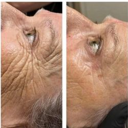 Wax Poetic By Leslie - Procell Therapy treatments Before/After