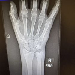 Coastal Orthopedics - Lakewood Ranch - Broken wrist