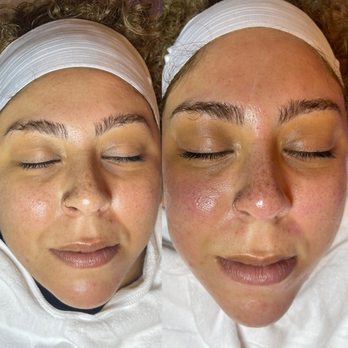 Rejuved Aesthetics - Client results before and after Dermaplaning, Hydrafacial and LED LIGHT Therapy. - Skin Care Near Me - Alameda, California Rejuved Aesthetics - Client results before and after Dermaplaning, Hydrafacial and LED LIGHT Therapy. - Skin Care Near Me - Alameda, California