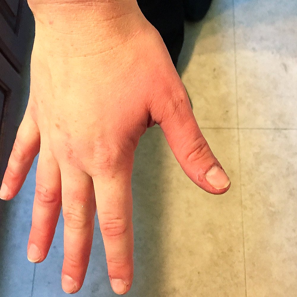 Reaction after it had started to get better.  Thumb is red and hand is puffy :(