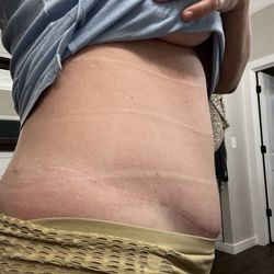 Regional Plastic Surgery Center - Bulge