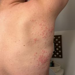 BEDBUG BITES! BEDBUG BITES!