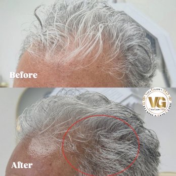 VitaGlowMD - Hair Restoration Treatment by Dr Famoori - Medical Spas Near Me - San Jose, California VitaGlowMD - Hair Restoration Treatment by Dr Famoori - Medical Spas Near Me - San Jose, California