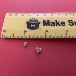 Lander Medical Clinic - Two tonsil stones removed by highly competent RN (Hannah) at Sage West Hospital in Lander, WY