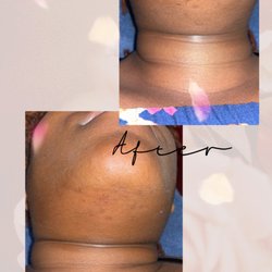 Face It Facial Studio - Before and after chin wax