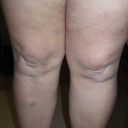 Legacy Vein Clinic - Patient 4 - varicose vein treatment AFTER