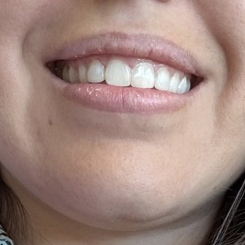 Maye Lazaar, DDS - Smiles By Design Dentistry - After - General Dentistry Near Me - Los Gatos, California Maye Lazaar, DDS - Smiles By Design Dentistry - After - General Dentistry Near Me - Los Gatos, California