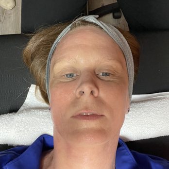 Philly Wellness Center - Cryoskin facial procedure - Weight Loss Centers Near Me - Philadelphia, Pennsylvania Philly Wellness Center - Cryoskin facial procedure - Weight Loss Centers Near Me - Philadelphia, Pennsylvania