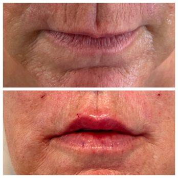 Ritz XV - Before/After lip filler - Medical Spas Near Me - Austin, Texas Ritz XV - Before/After lip filler - Medical Spas Near Me - Austin, Texas