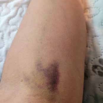 Labcorp at Walgreens - Technician messed up drawing my blood, causing a lot of bruising. - Laboratory Testing Near Me - Hudson, Florida Labcorp at Walgreens - Technician messed up drawing my blood, causing a lot of bruising. - Laboratory Testing Near Me - Hudson, Florida