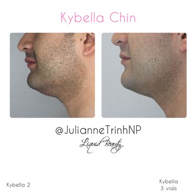 Kybella - Say goodbye to the double chin—no surgery needed. Kybella is an FDA-approved injectable that targets and dissolves submental fat beneath the chin. With a series of treatments, you can achieve a more defined jawline and a slimmer profile—on your terms, at your pace