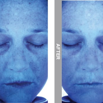 Bali Spa - HydraFacial Before and After - Day Spas Near Me - Portland, Oregon Bali Spa - HydraFacial Before and After - Day Spas Near Me - Portland, Oregon