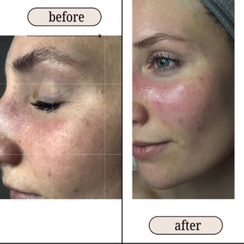 Daria Face Care - Before & after: hydrated skin with restored epidermal barrier. - Estheticians Near Me