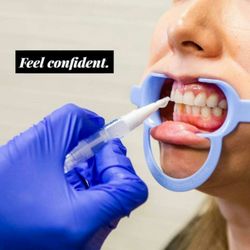 TotalBright Teeth Whitening