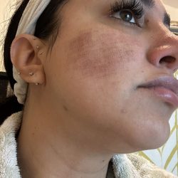 Diane Walder, MD - My entire cheeks weren't treated this is 2 days after