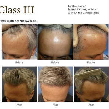 Meshkin Medical - Class 3,2500 grafts - Hair Loss Centers Near Me - Glendale, California Meshkin Medical - Class 3,2500 grafts - Hair Loss Centers Near Me - Glendale, California
